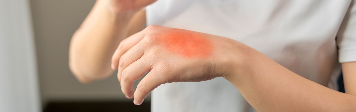 Paid Clinical Trials for Eczema
